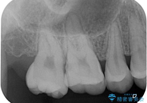 【セラミックインレー】咬合面のカリエスの治療前