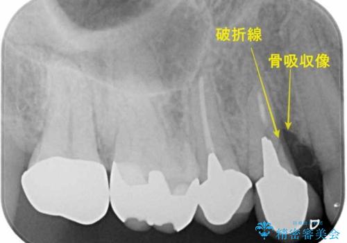 【インプラント】2ヵ月前から歯に違和感があるので診て欲しい! 歯根破折の治療前