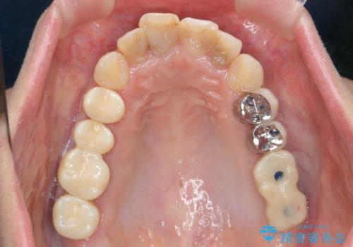 インプラント・セラミック・矯正治療を含む包括歯科診療の治療中
