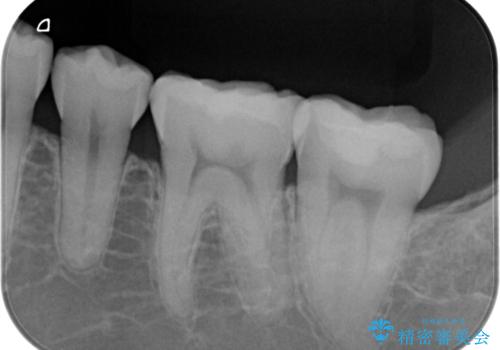 銀歯の横が虫歯、自費治療でやり直してセラミックにの治療後