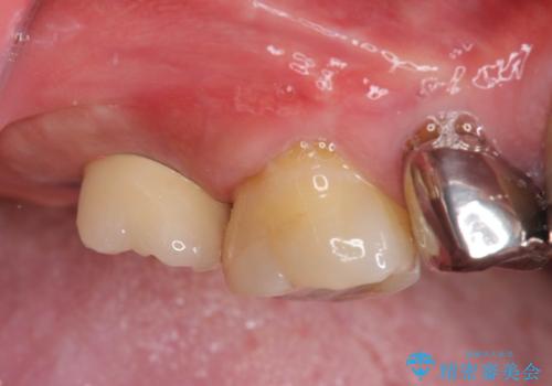 [ 歯槽堤保存術 ] [ 奥歯の破折 ]  ソケットプリザベーションを併用したインプラント治療の症例 治療後