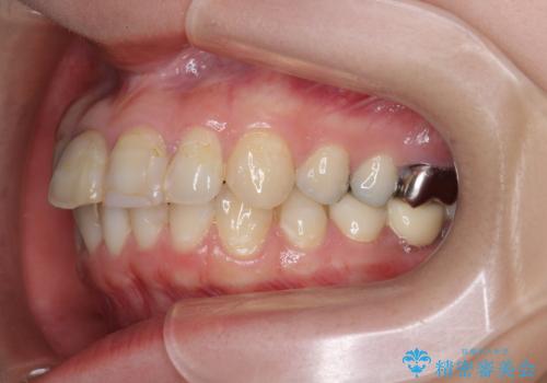 インプラント・セラミック・矯正治療を含む包括歯科診療の治療前