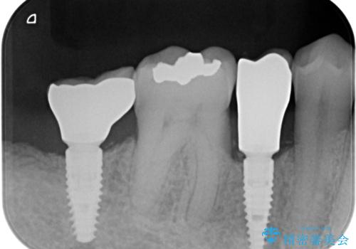[ 失った歯の機能を回復 ] 奥歯のインプラント治療の治療後