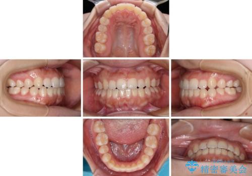 前歯のクロスバイトを改善 インビザライン・モデレートによる矯正治療の治療中