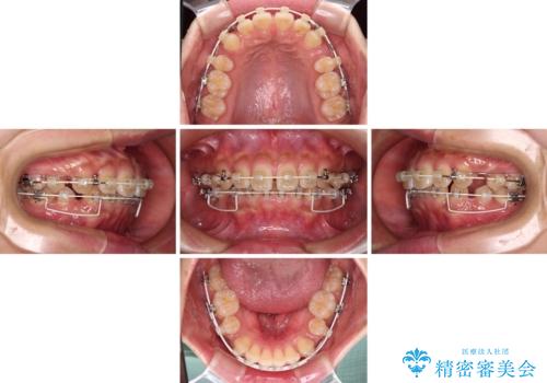 くちばしのような前歯 抜歯矯正で口を閉じやすくの治療中