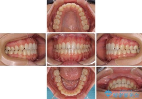 【モニター】オープンバイトをインビザライン矯正で治すの治療中