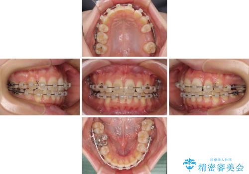 矯正の後戻りと奥歯の欠損 ワイヤー矯正とインプラント治療の治療中