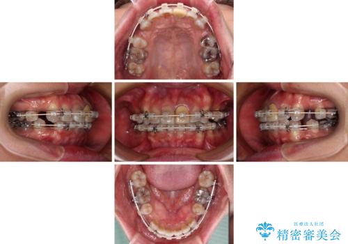 突出した前歯を引っ込める ワイヤー装置での抜歯矯正の治療中