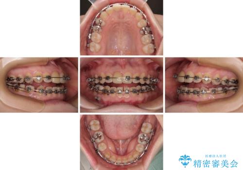【モニター】後戻りでできた隙間 ワイヤー装置での再矯正の治療中