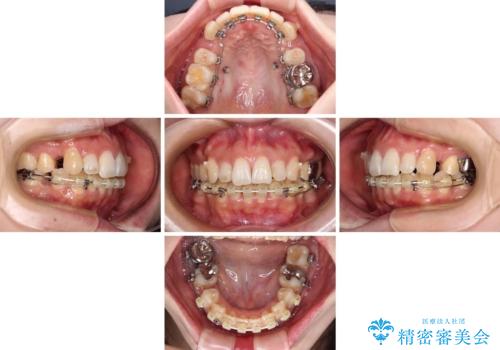 目立たない裏側装置でデコボコをきれいに解消の治療中