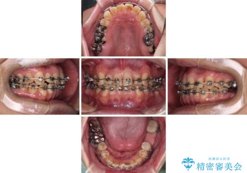激痛の奥歯のむし歯治療 折角なので矯正治療もしたいの治療中