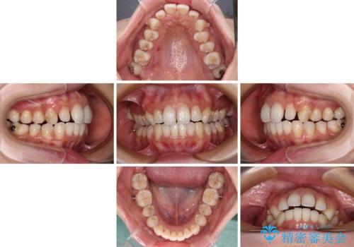 補助装置を用いて奥歯の咬み合わせを事前に改善　インビザラインによる矯正治療の治療中