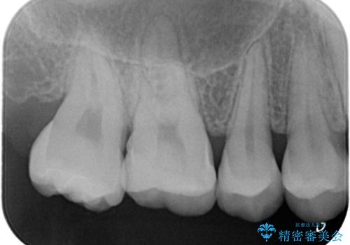 【セラミックインレー】咬合面のカリエスの治療後