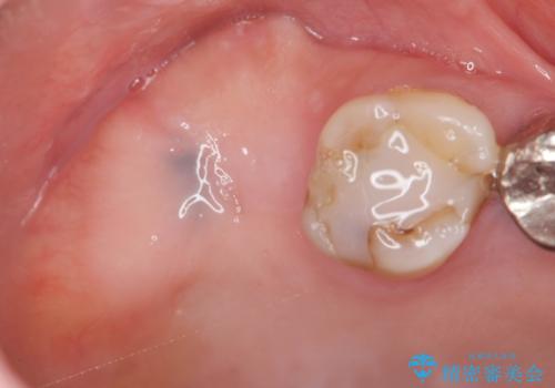 [ 歯槽堤保存術 ] [ 奥歯の破折 ]  ソケットプリザベーションを併用したインプラント治療の治療中