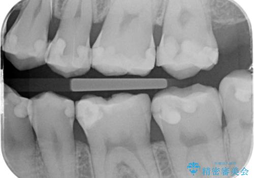 e-maxインレー治療の治療前