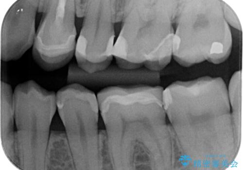 精度の低い詰め物のやり替えの治療前