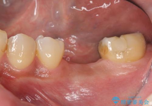 失った奥歯をインプラントで機能回復の症例 治療前
