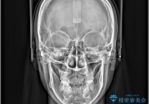 【抜歯矯正】クリア装置で1年半の治療前