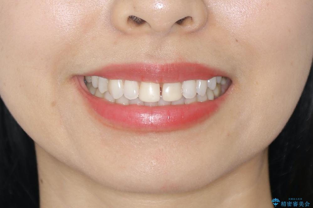 すきっ歯を治したい。インビザライン・ライトによる矯正治療の治療前(顔貌)