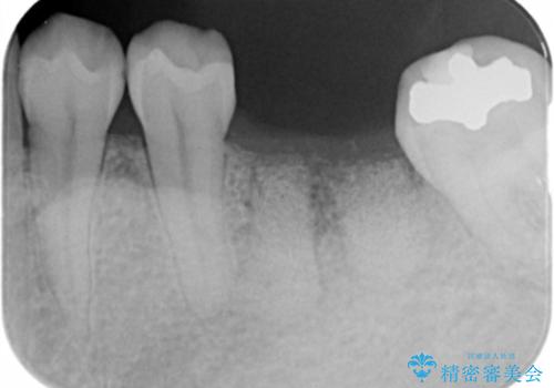 失った奥歯をインプラントで機能回復の治療前