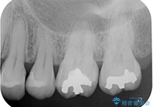 歯に穴があいてフロスが引っかかる　セラミックインレー修復の治療後