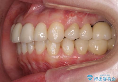 インプラント・セラミック・矯正治療を含む包括歯科診療の治療後