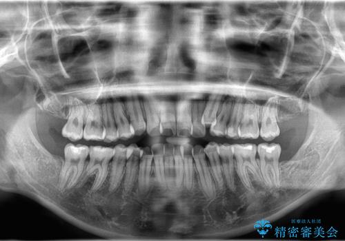 【抜歯矯正】クリア装置で1年半の治療前