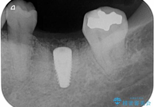 失った奥歯をインプラントで機能回復の治療中