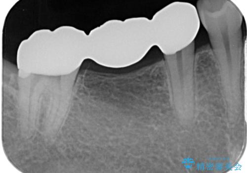 金属のブリッジをやり替えたいの治療後