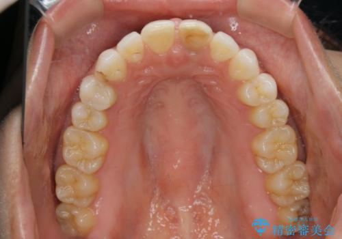 すきっ歯を治したい。インビザライン・ライトによる矯正治療の治療前