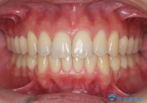 過蓋咬合・上顎前突・叢生を改善するマウスピース矯正の治療後