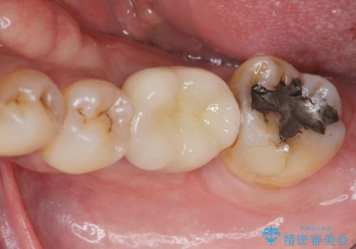 失った奥歯をインプラントで機能回復の治療後