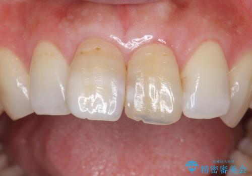 変色した歯を綺麗にしたい 根管治療からジルコニアクラウンでの修復