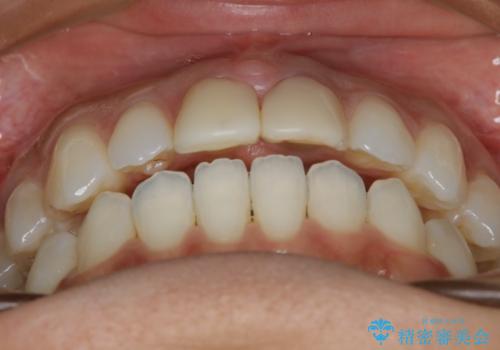 すきっ歯を治したい。インビザライン・ライトによる矯正治療の治療後