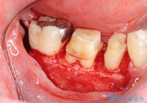 深い虫歯 セラミッククラウンの精度を高める歯周外科手術の治療中