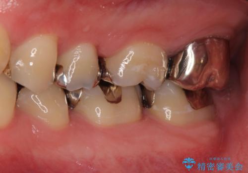 APF(歯肉弁根尖側移動術)の症例 治療前