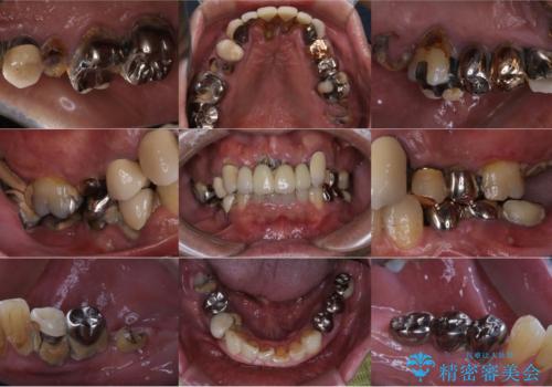孫から口臭を指摘され来院、全顎治療で噛み合わせ、見た目、口臭全て劇的改善!の治療前