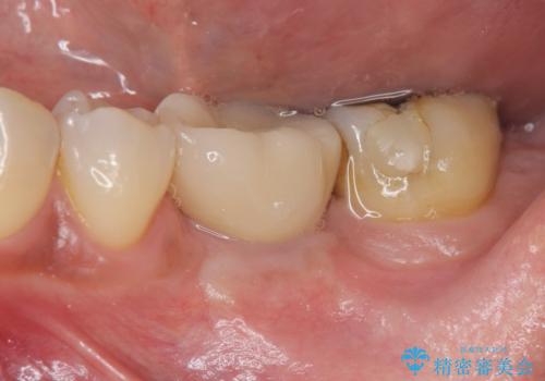 失った奥歯をインプラントで機能回復の症例 治療後