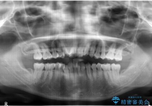 犬歯が歯ぐきにうまっている 真ん中のずれ、出っ歯を治したいの治療前
