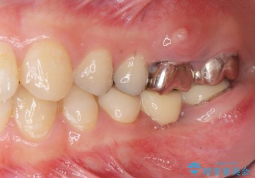 インプラント・セラミック・矯正治療を含む包括歯科診療の治療前