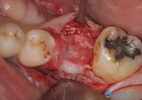 失った奥歯をインプラントで機能回復の治療中