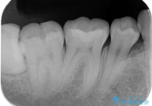 【セラミックインレー】銀歯を外したいの治療後