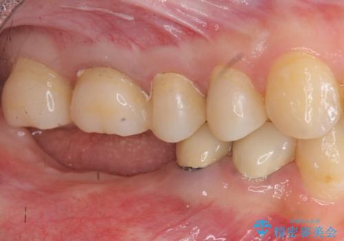 インプラント・セラミック・矯正治療を含む包括歯科診療の治療中