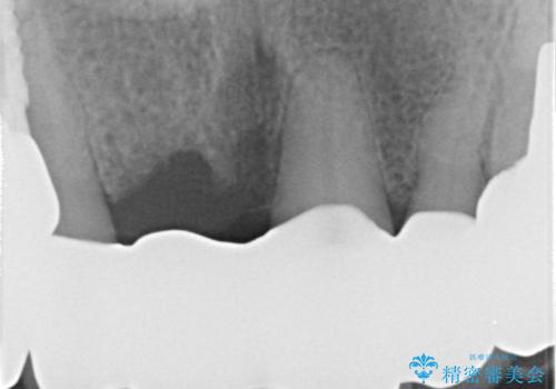 前歯がグラグラする。の治療後