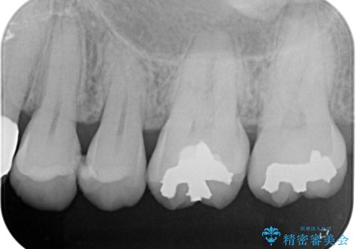 歯に穴があいてフロスが引っかかる セラミックインレー修復の治療前