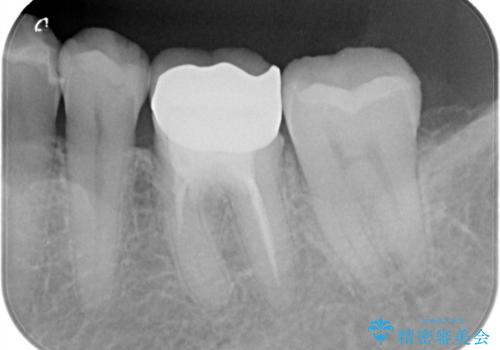 銀歯がとれた セラミックインレーで修復の治療後