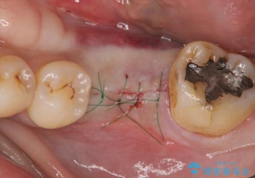 失った奥歯をインプラントで機能回復の治療中