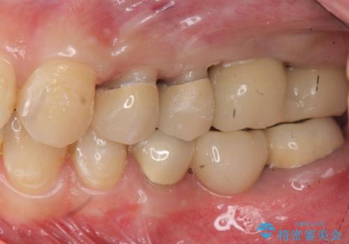 インプラント・セラミック・矯正治療を含む包括歯科診療の治療中