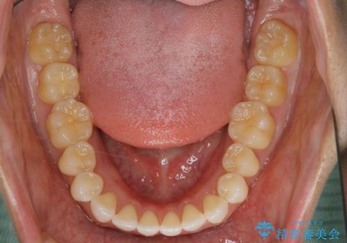 すきっ歯を治したい。インビザライン・ライトによる矯正治療の治療後