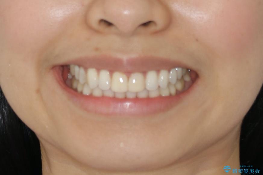 すきっ歯を治したい。インビザライン・ライトによる矯正治療の治療後(顔貌)